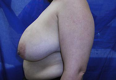 Before Results for Breast Reduction