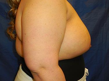 After Results for Breast Augmentation