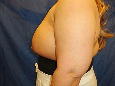 After Results for Breast Augmentation