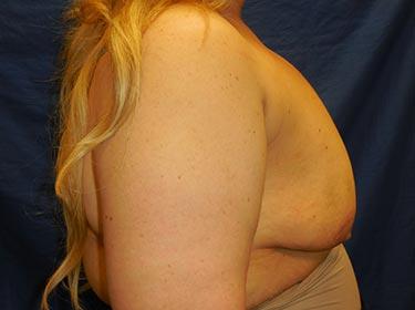 Before Results for Breast Augmentation