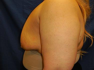 Before Results for Breast Augmentation