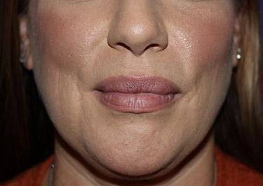 After Results for Lip Augmentation