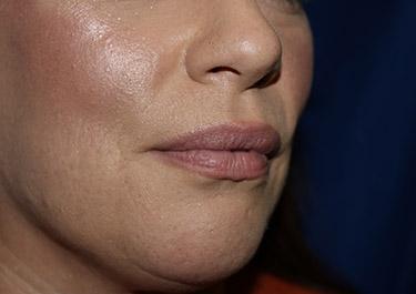 After Results for Lip Augmentation