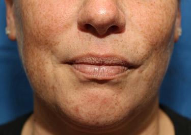 Before Results for Lip Augmentation