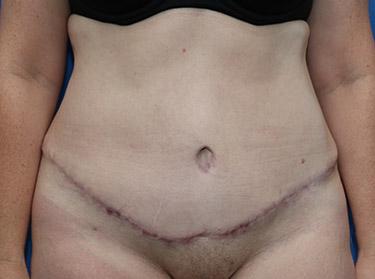 After Results for Tummy Tuck