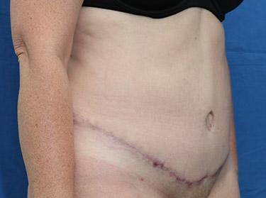 After Results for Tummy Tuck