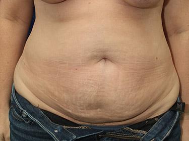 Before Results for Tummy Tuck