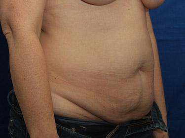 Before Results for Tummy Tuck