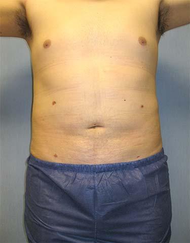 After Results for Liposuction