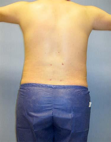 After Results for Liposuction