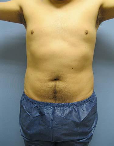 Before Results for Liposuction