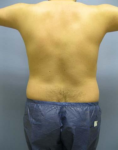 Before Results for Liposuction