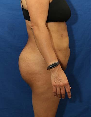 After Results for Liposuction, Brazilian Butt Lift / Gluteal Augmentation