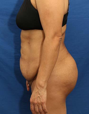 After Results for Gluteal Augmentation