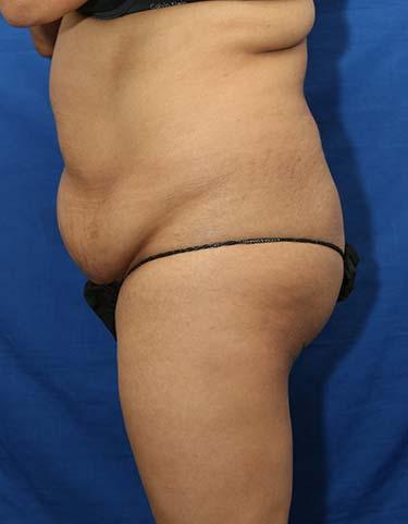 Before Results for Gluteal Augmentation