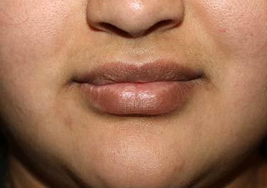 After Results for Tissue Fillers, Lip Augmentation