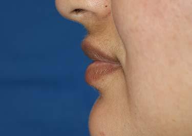 After Results for Tissue Fillers, Lip Augmentation