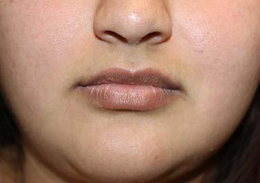 Before Results for Tissue Fillers, Lip Augmentation