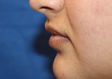 Before Results for Tissue Fillers, Lip Augmentation