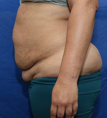 Before Results for Panniculectomy