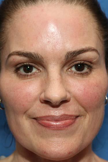 After Results for Tissue Fillers