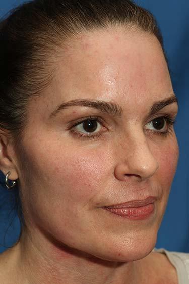 After Results for Tissue Fillers