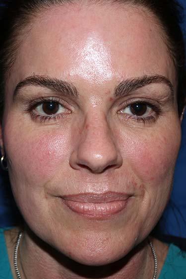 Before Results for Tissue Fillers