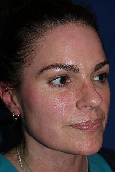 Before Results for Tissue Fillers