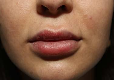 After Results for Tissue Fillers, Lip Augmentation