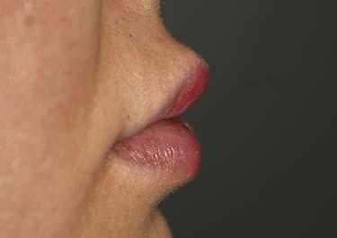 After Results for Tissue Fillers, Lip Augmentation