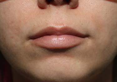 Before Results for Lip Augmentation