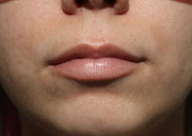 Before Results for Tissue Fillers, Lip Augmentation
