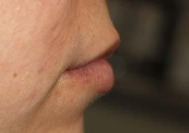 Before Results for Tissue Fillers, Lip Augmentation