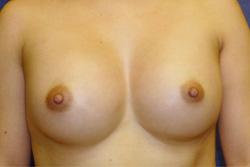 After Results for Breast Augmentation