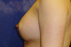 After Results for Breast Augmentation