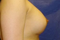 After Results for Breast Augmentation