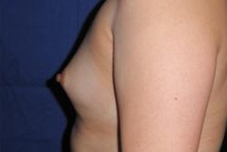 Before Results for Breast Augmentation