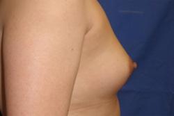 Before Results for Breast Augmentation