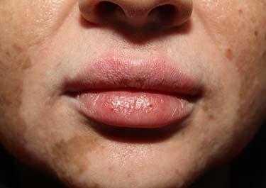 After Results for Lip Augmentation