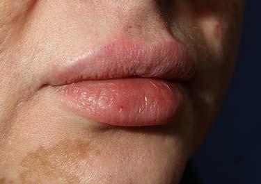 After Results for Lip Augmentation