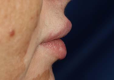 After Results for Lip Augmentation