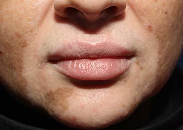Before Results for Lip Augmentation