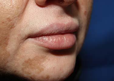 Before Results for Tissue Fillers, Lip Augmentation