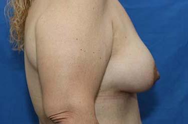 After Results for Breast Lift