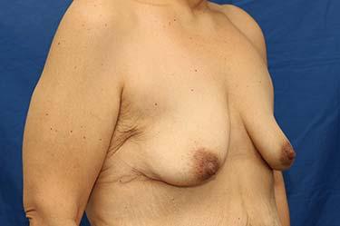 Before Results for Breast Lift / Mastopexy