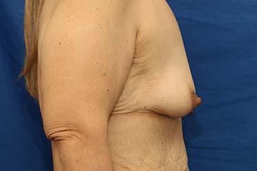 Before Results for Breast Lift