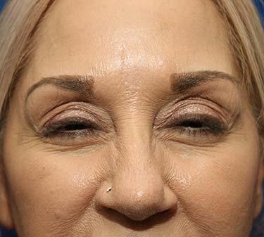 After Results for Botox