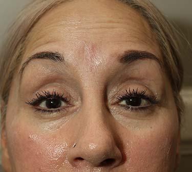 Before Results for Neuromodulators (Botox / Dysport)