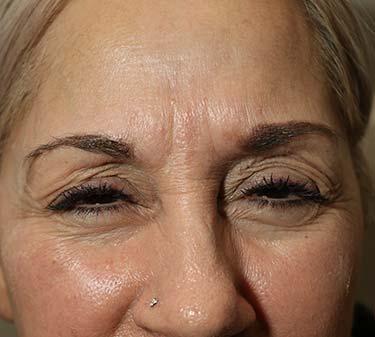 Before Results for Botox