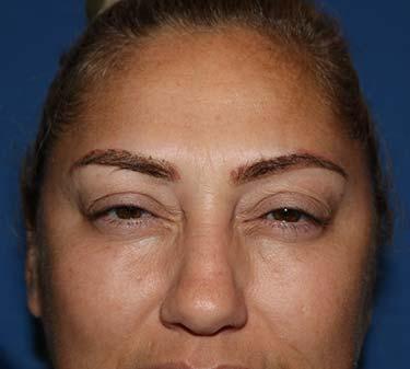 After Results for Neuromodulators (Botox / Dysport)